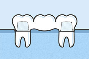 The image is a simple, cartoon-style illustration of two white teeth with toothpaste bristles, floating above water, suggesting dental hygiene.