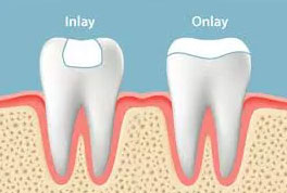 The image is a medical illustration showing two stages of dental implant placement  the initial stage with an implant placed into the jawbone, and the final stage where the tooth has been attached to the implant.