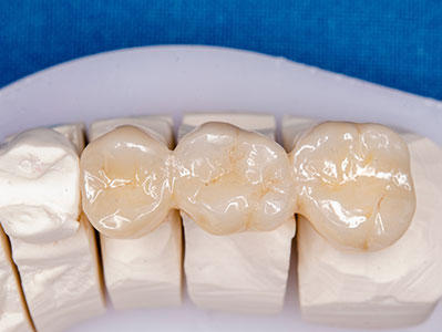 Dental implant set with a natural tooth shade, displayed on a white background.