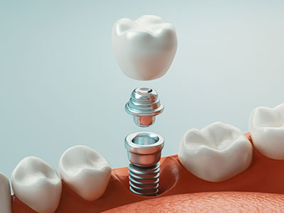 The image displays a close-up of a human tooth with a small, metallic screw inserted into it, next to a dental implant fixture embedded in the gum.