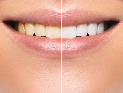 A before-and-after comparison of a person s teeth, highlighting the difference between uncleaned and professionally cleaned teeth.