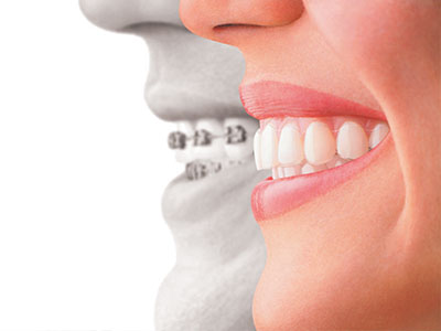 The image is a composite of two photographs  one shows a smiling woman with straight teeth, and the other is an inset photo of a man s face obscured by a large, transparent mouthpiece, which appears to be a dental appliance.